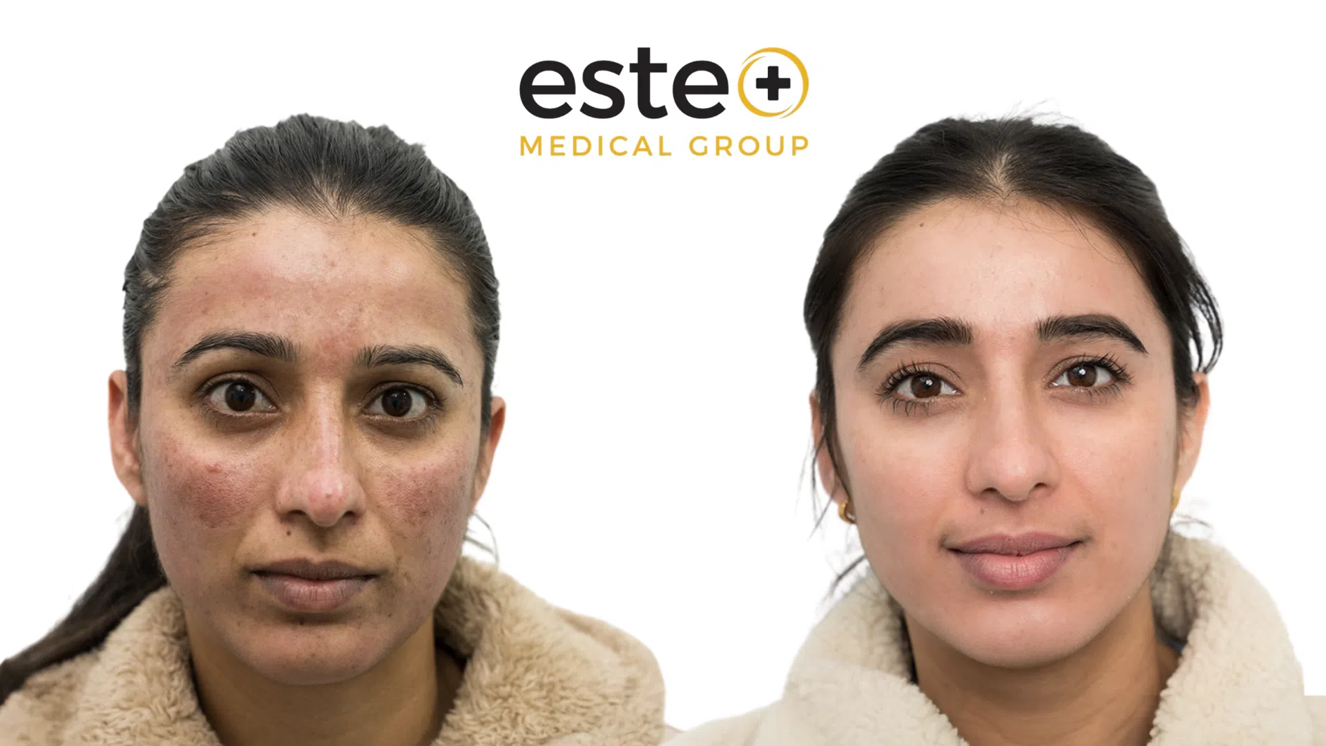 Exciplex (Alopecia Treatment) Life Changing Transformation After and Before Image