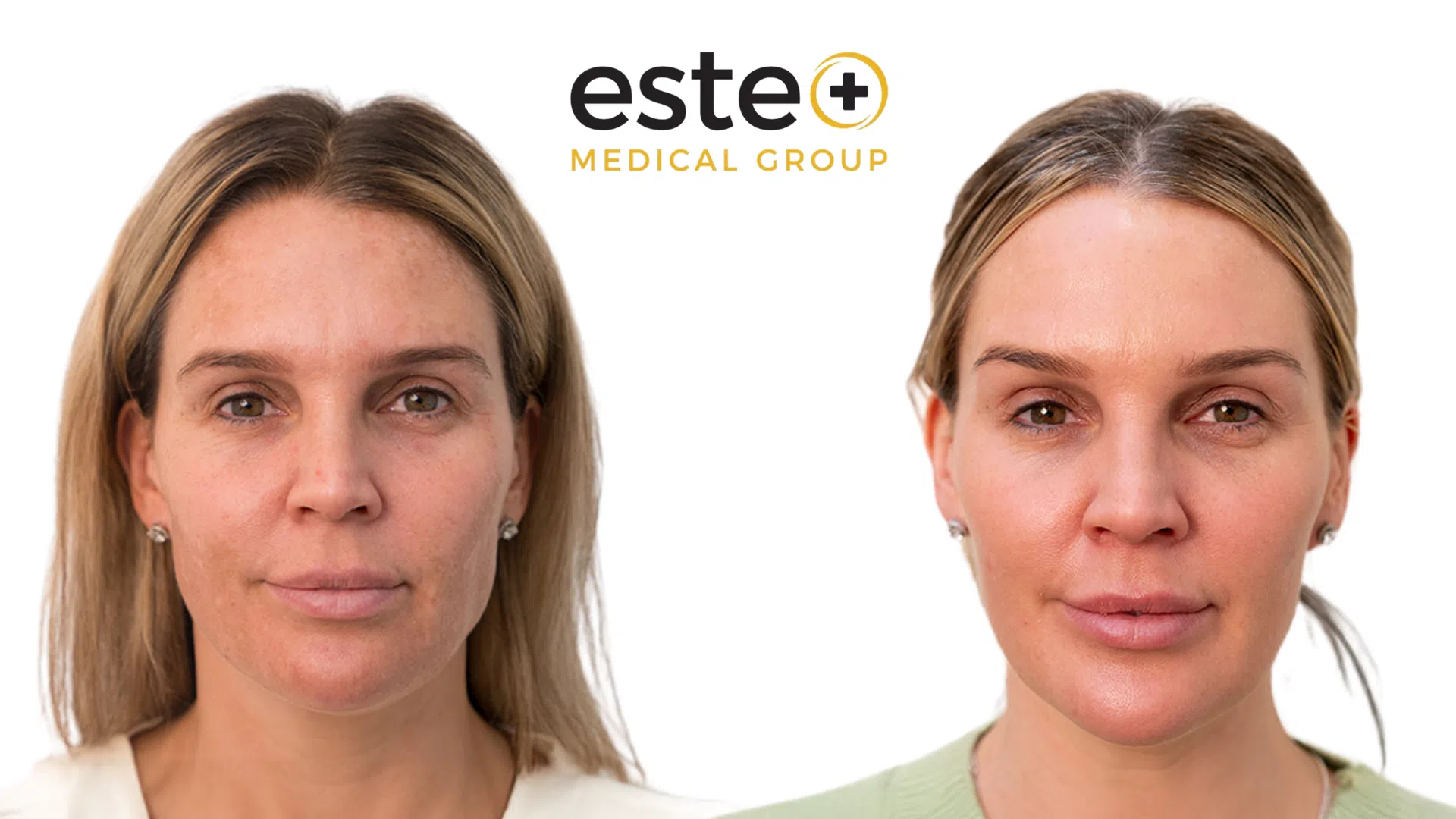 Pigmentation Life Changing Transformation After and Before Image