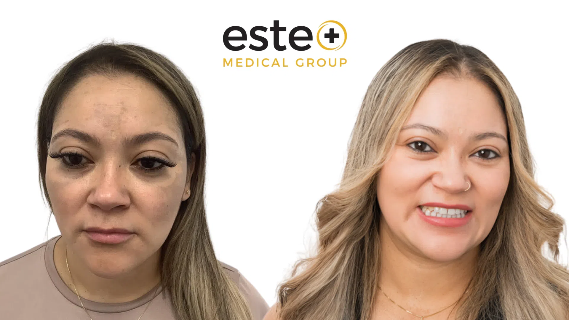 Pigmentation Life Changing Transformation After and Before Image