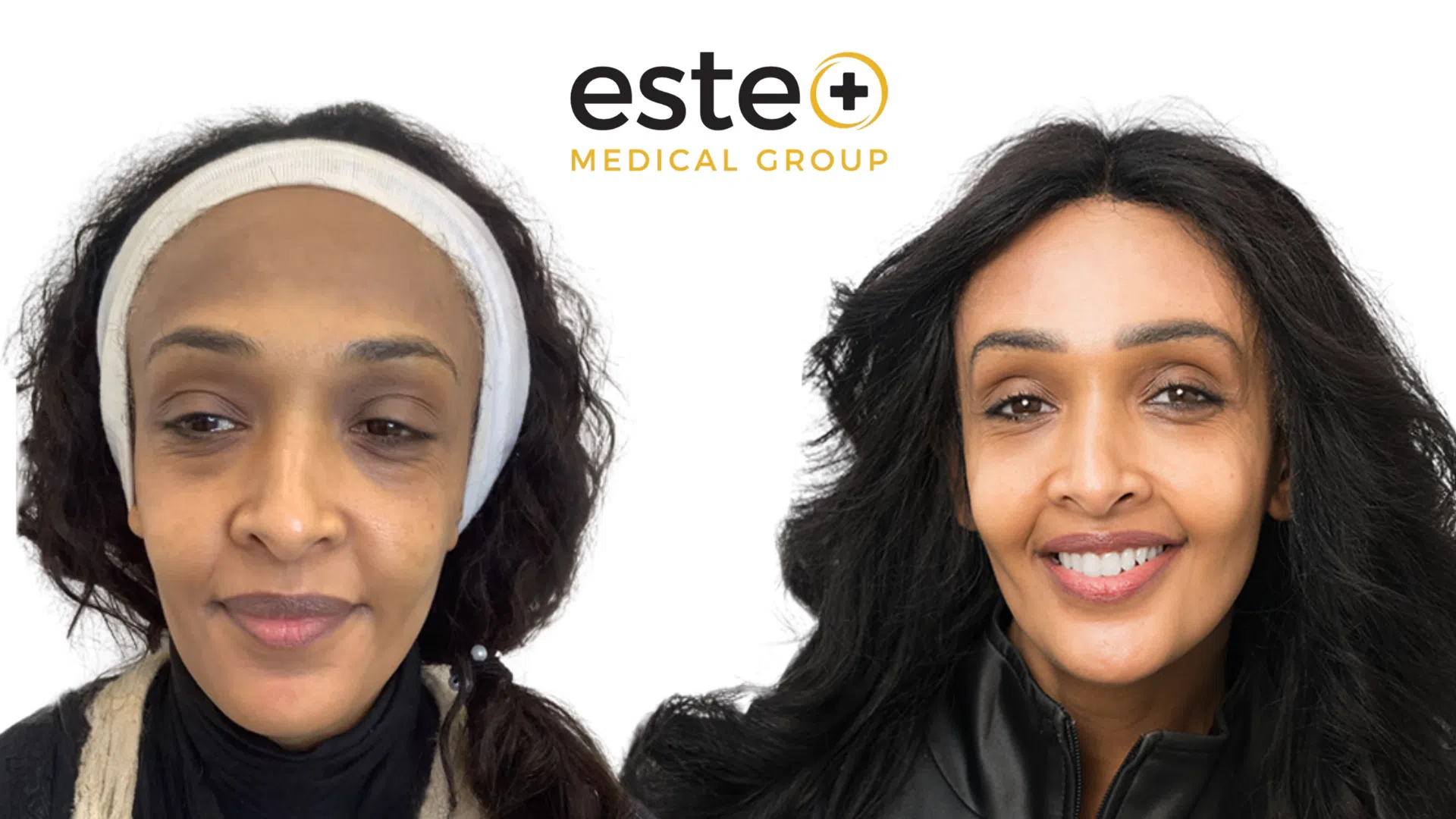 Pigmentation Life Changing Transformation