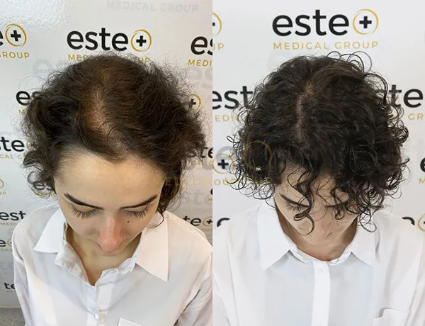 66fd26780ee5c97dfa753c0a_65c38a93db3d098d178c70f1_Female-hair-loss-2jpg_20(1)
