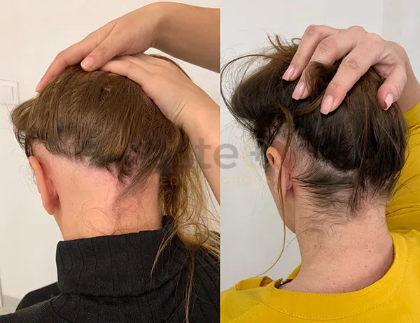 66fd267819d4981b93eb7d22_65c38a92c7b017e0aa896ebb_Woman-hair-regrowth