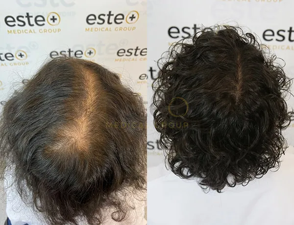 66fd2678949ce994a074d96b_65c38a940c719cb23b47f2ba_Female-hair-loss--3_20(1)