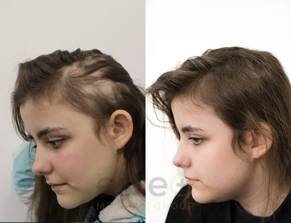 66fd2679bd18ed9b04aea014_667d8fc17ea674f4c3d9bfee_Alicoia_-Before-after-1