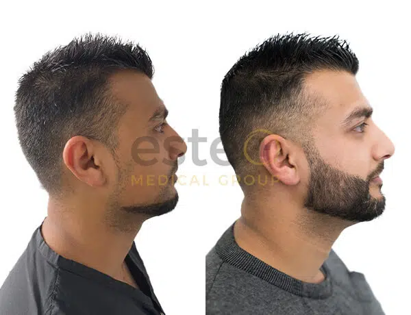 Beard Hair Transplant in Dubai After and Before Image