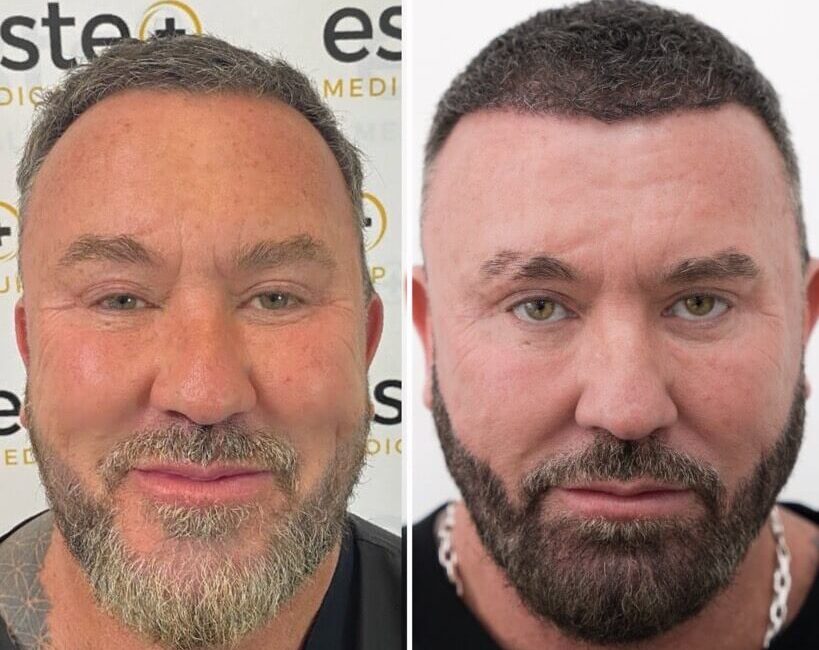 670e46c01eb079983eb27849_beard-results-2