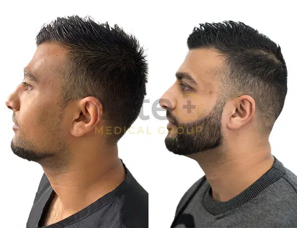 Beard Hair Transplant in Dubai After and Before Image