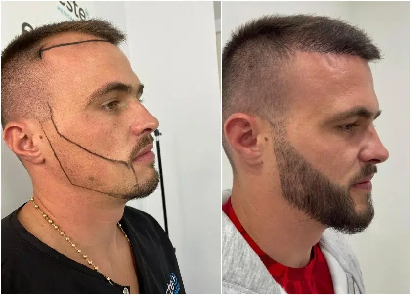 Beard Hair Transplant in Dubai After and Before Image