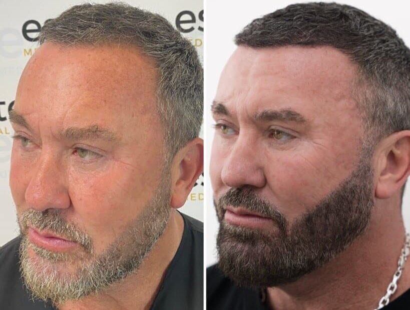 670e46c0822e237fb9f04e8f_beard-results-3