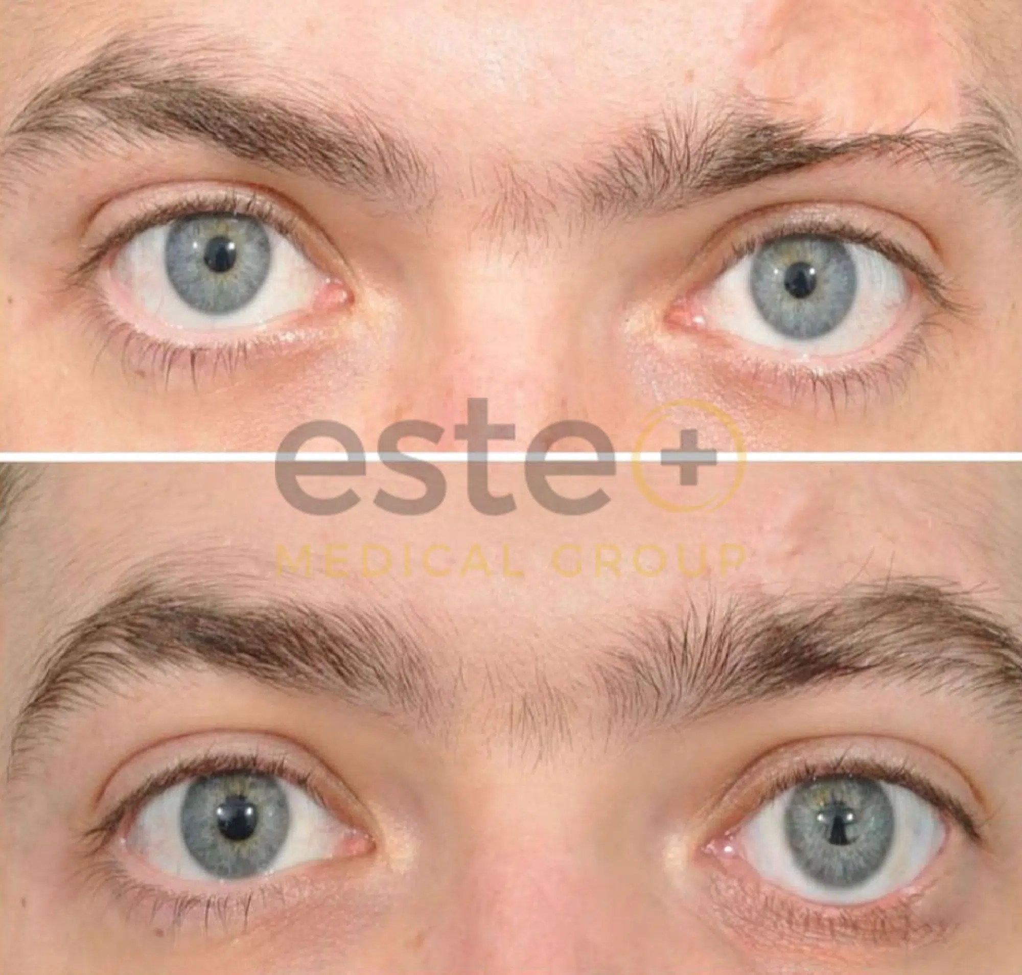 Eyebrow Hair Transplant After and Before Image