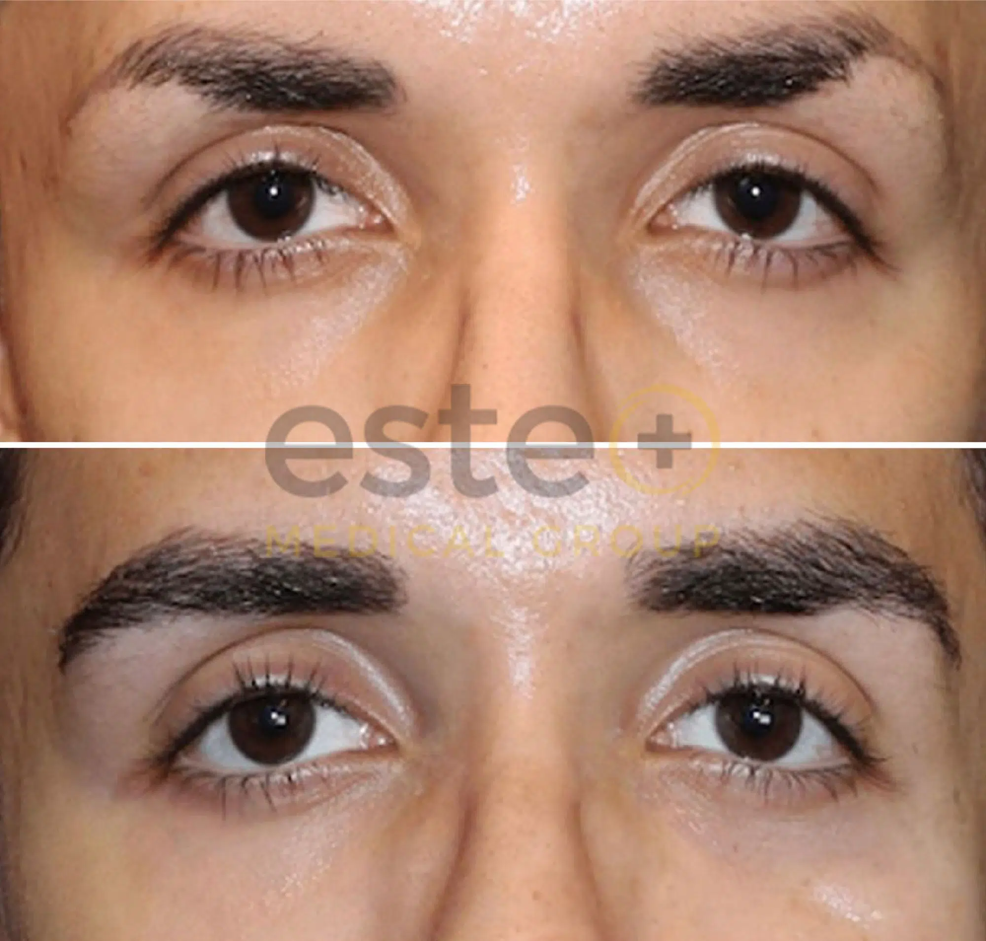 Eyebrow Hair Transplant After and Before Image