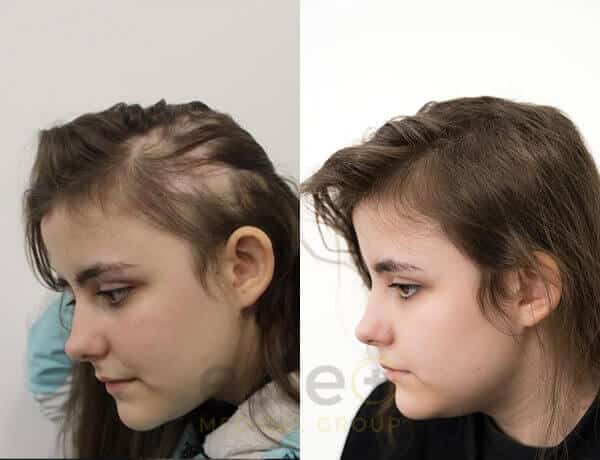 673dcd9e14bd40ab16d57286_alopecia results-10