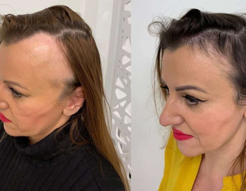 673dcd9e94f024a8acd24dd1_alopecia results-6