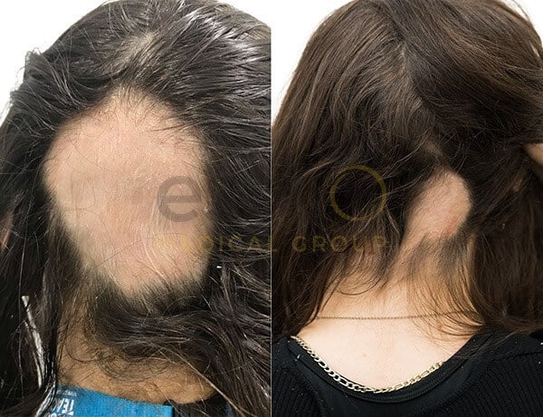 673dcd9e973147ae4982f751_Jasmin alopecia results