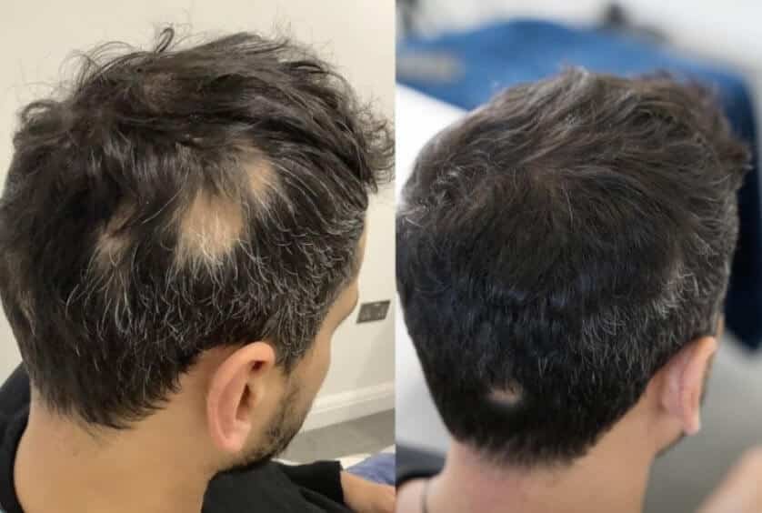 673dcd9eab68e25c296f9863_alopecia results-8