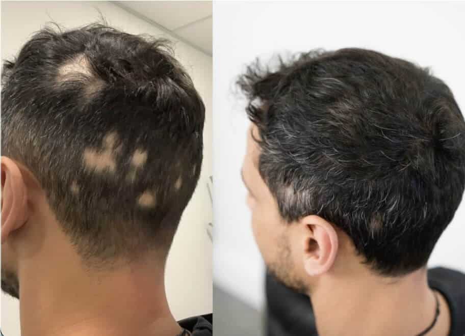 673dcd9ee9a94dba6eb764aa_alopecia results-9