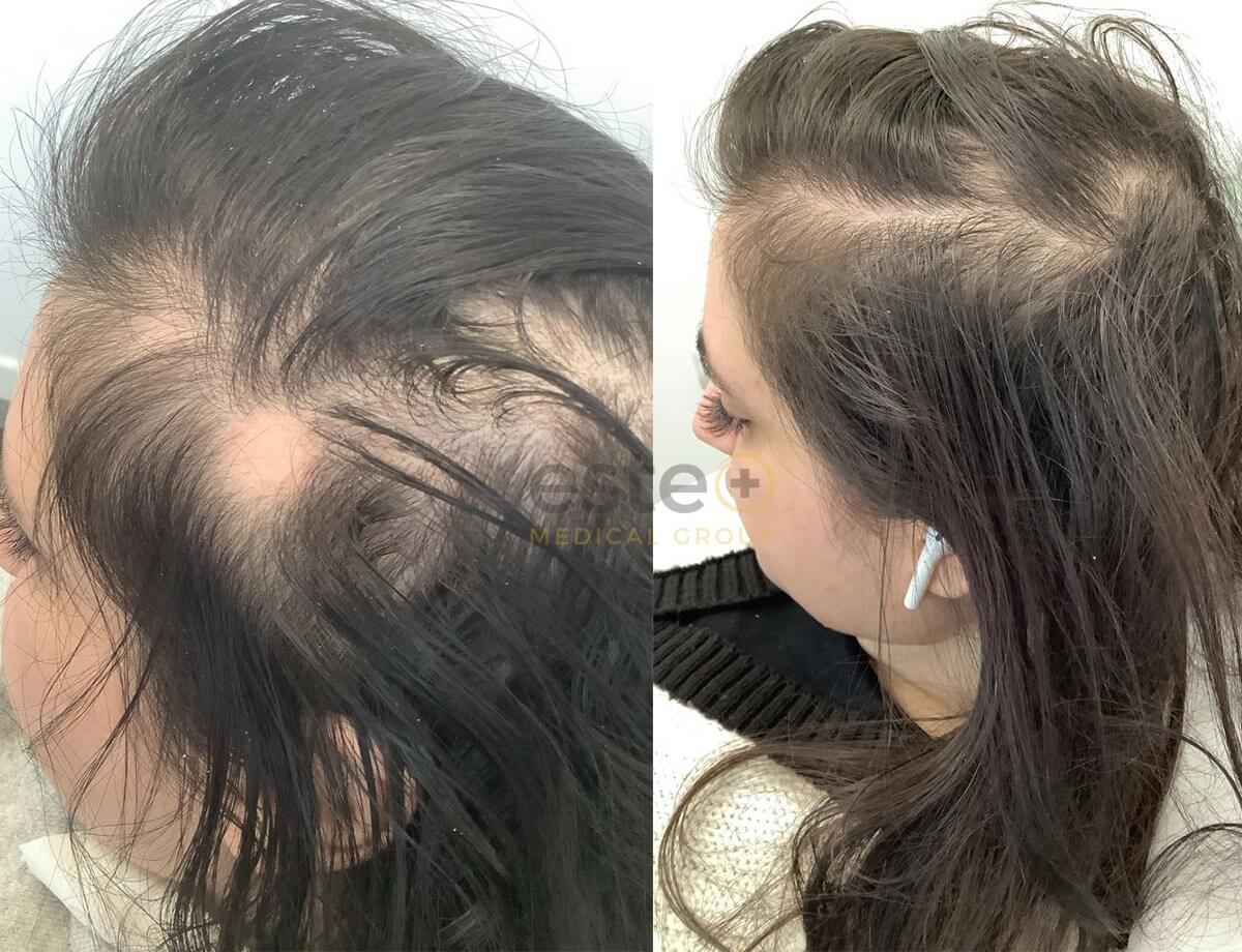 673dcd9f68c73ca7bcf143ae_alopecia results-1