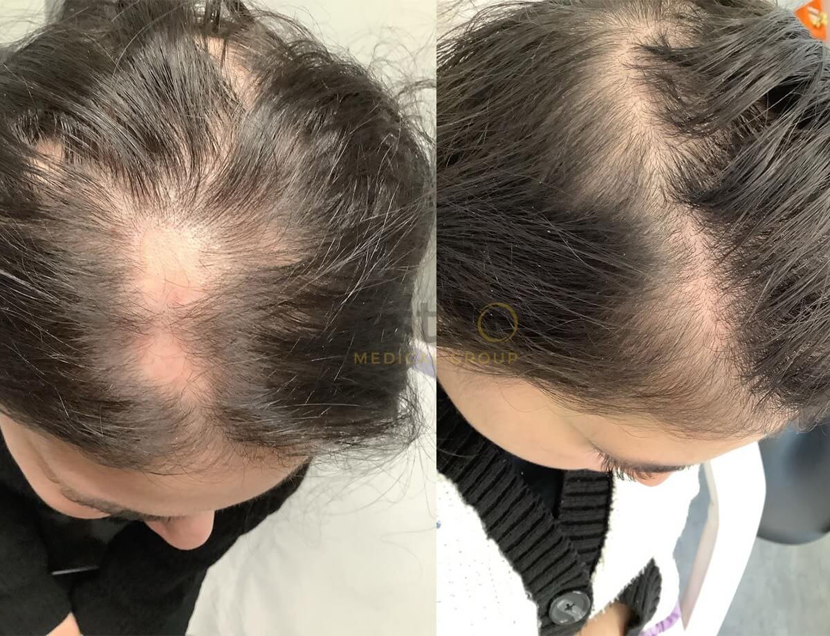 673dcd9fd0288c358fc7727a_alopecia results-3