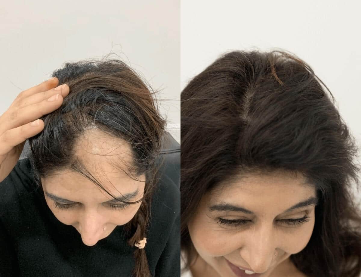 673dcda3c8821824f6ce215d_alopecia results-2