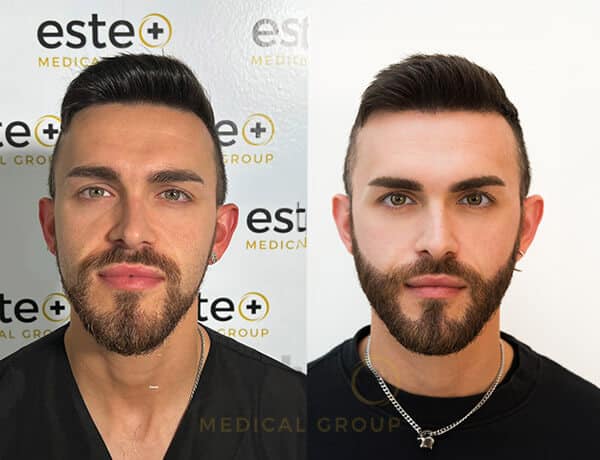 675828ddbfe1c863b8a536a6_Josh-Before-After