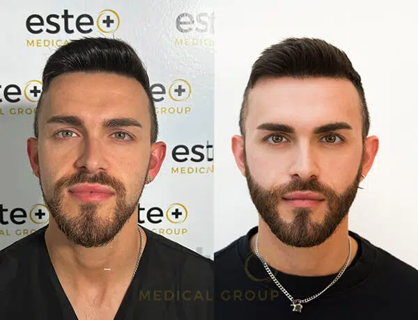 Beard Hair Transplant in Dubai After and Before Image