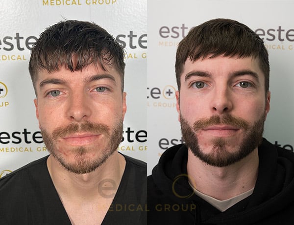 678a3e4585fb0a8f1fb742ac_Harry_-Before-after-1