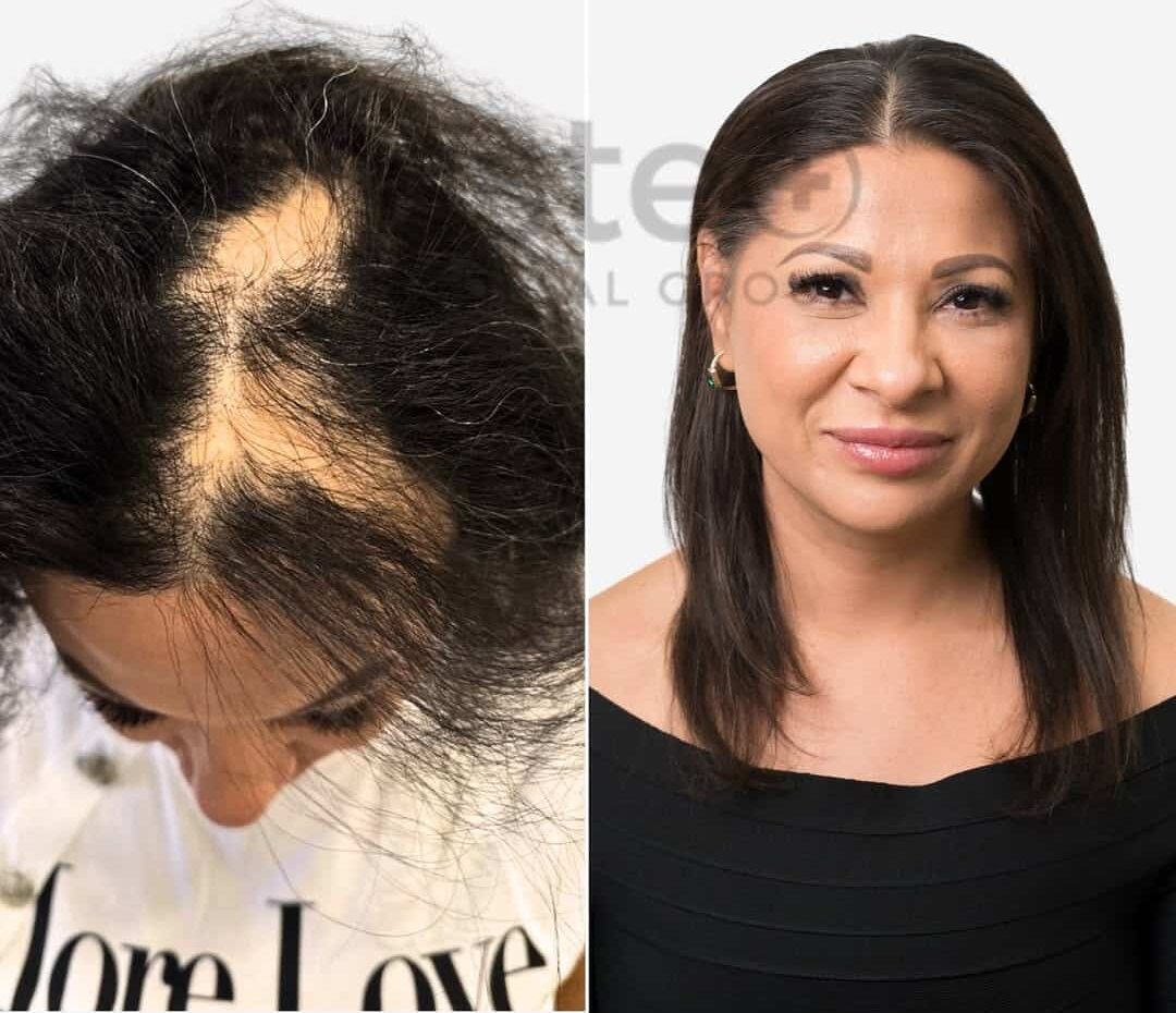 Before and After - Alopecia Treatment
