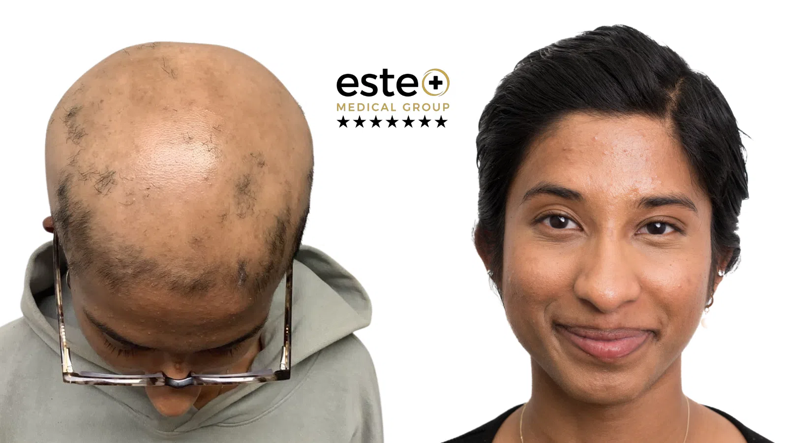 Exciplex (Alopecia Treatment) Life Changing Transformation After and Before Image