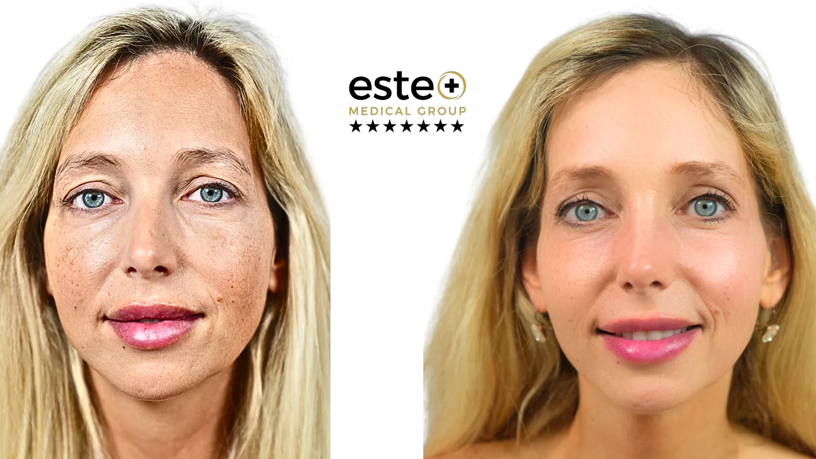 CO2 Laser treatment After and Before Image