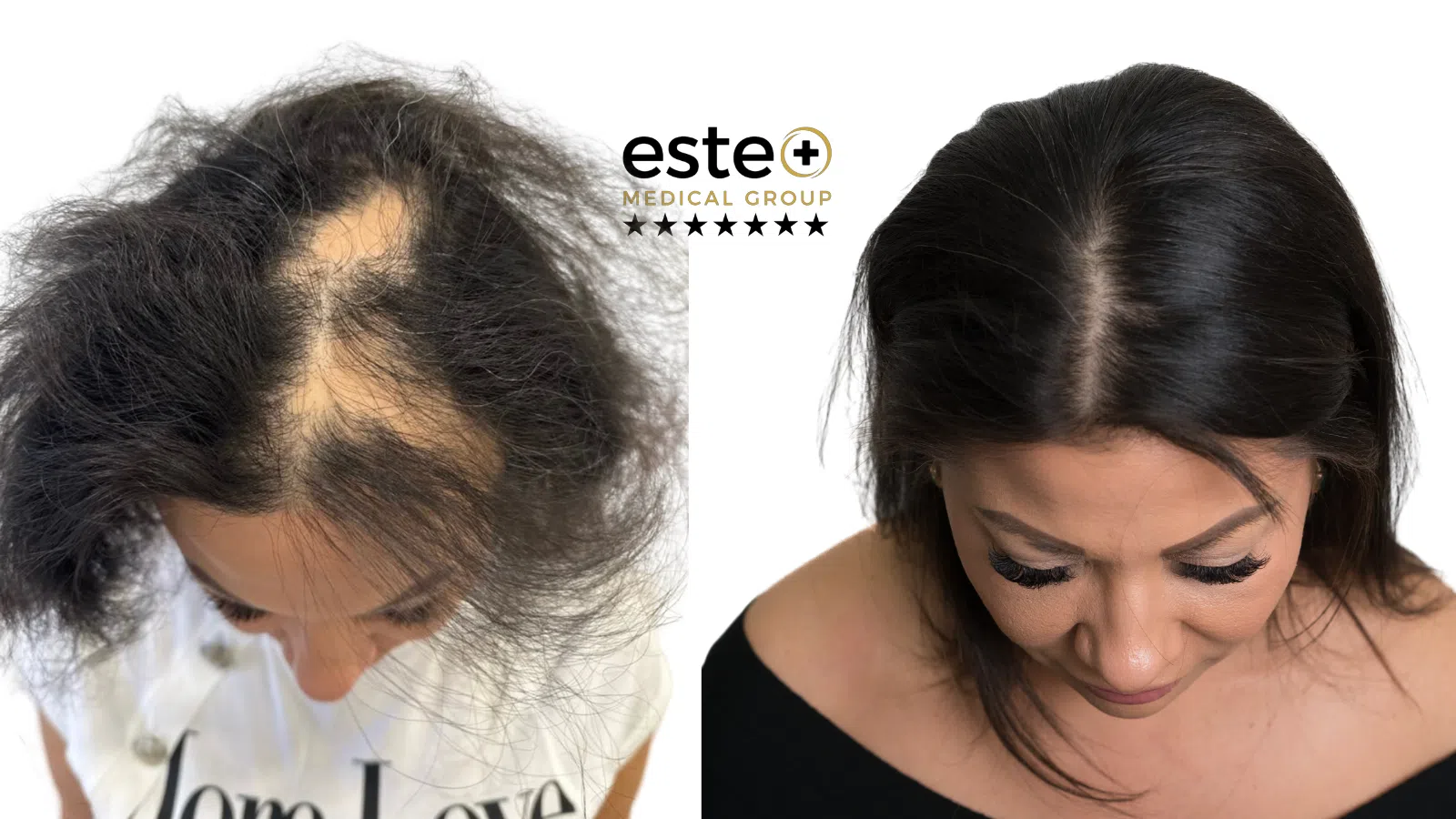 Exciplex (Alopecia Treatment) Life Changing Transformation