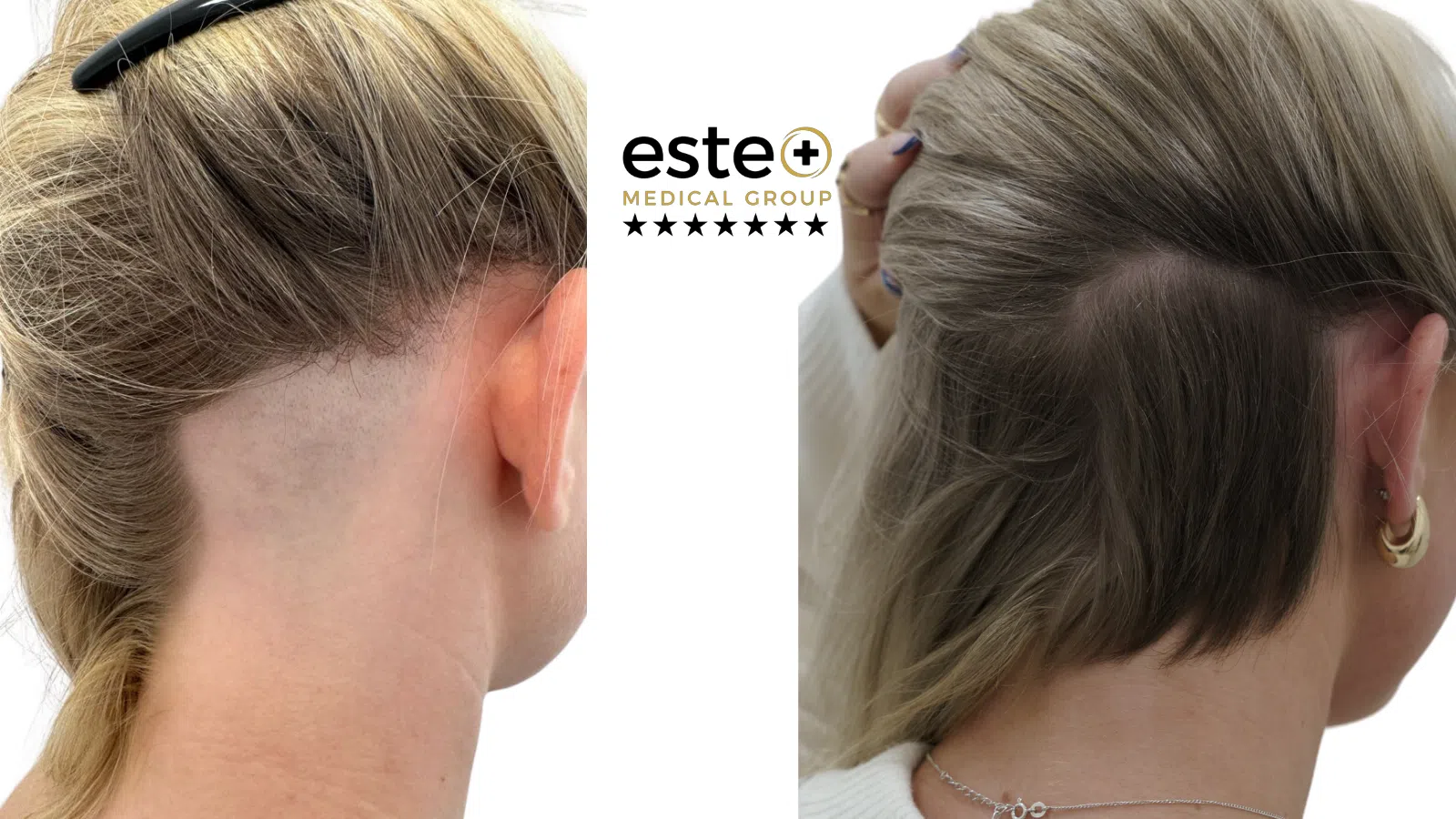 Exciplex (Alopecia Treatment) Life Changing Transformation