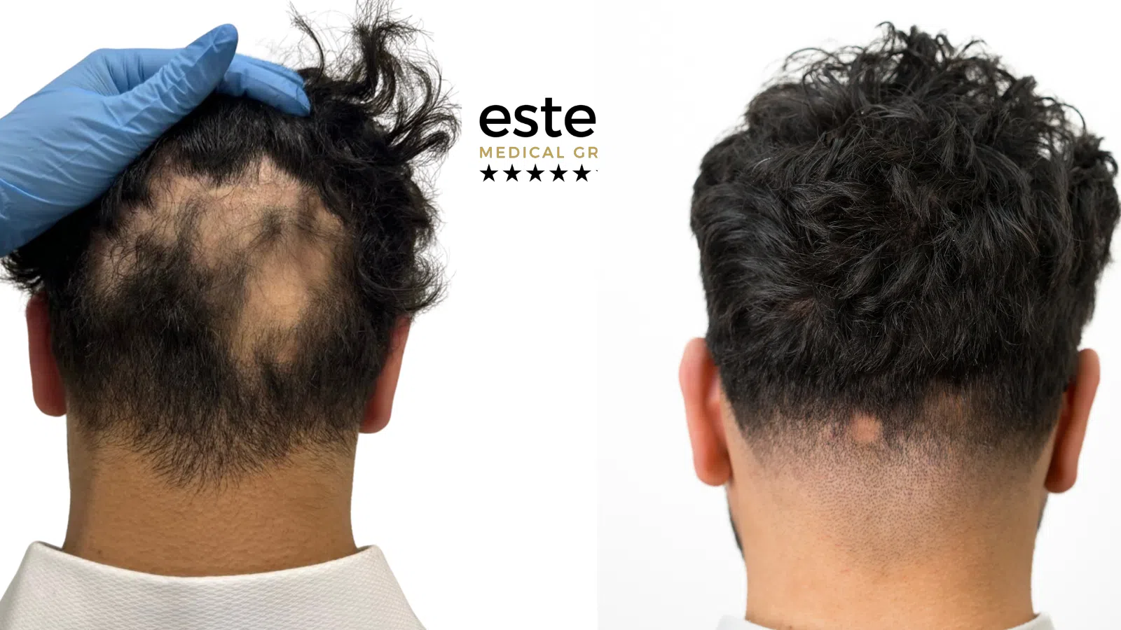 Exciplex (Alopecia Treatment) Life Changing Transformation After and Before Image