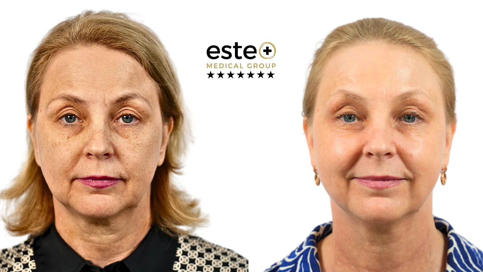 CO2 Laser treatment After and Before Image