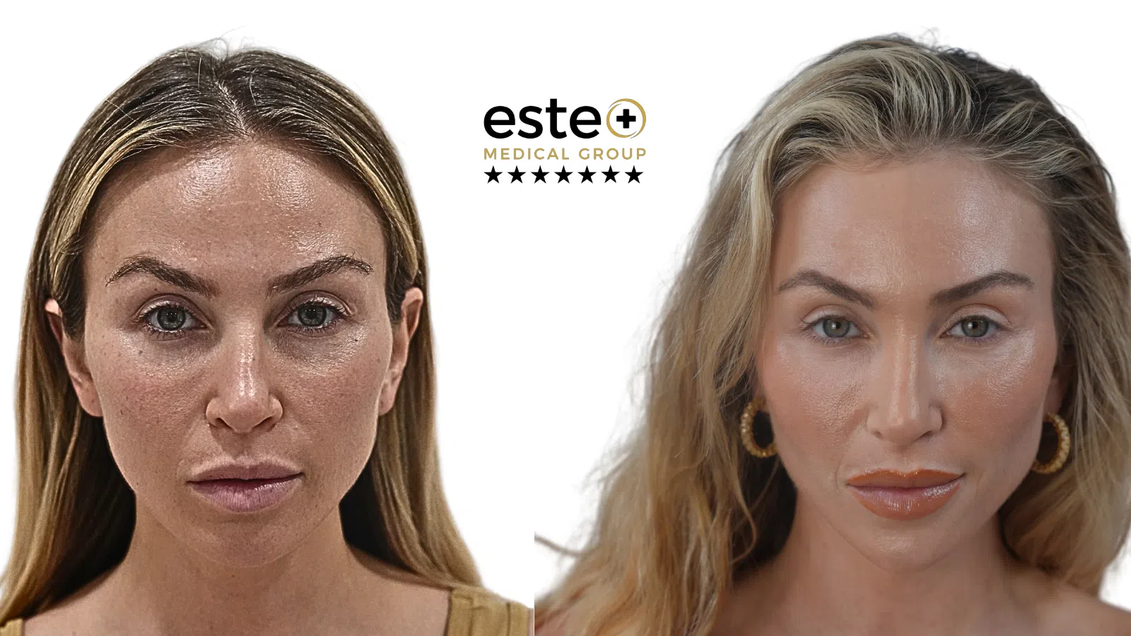 CO2 Laser treatment After and Before Image