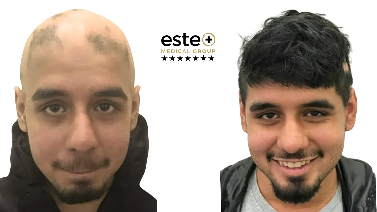 Robotic Dhi Hair Transplant Life Changing Transformation