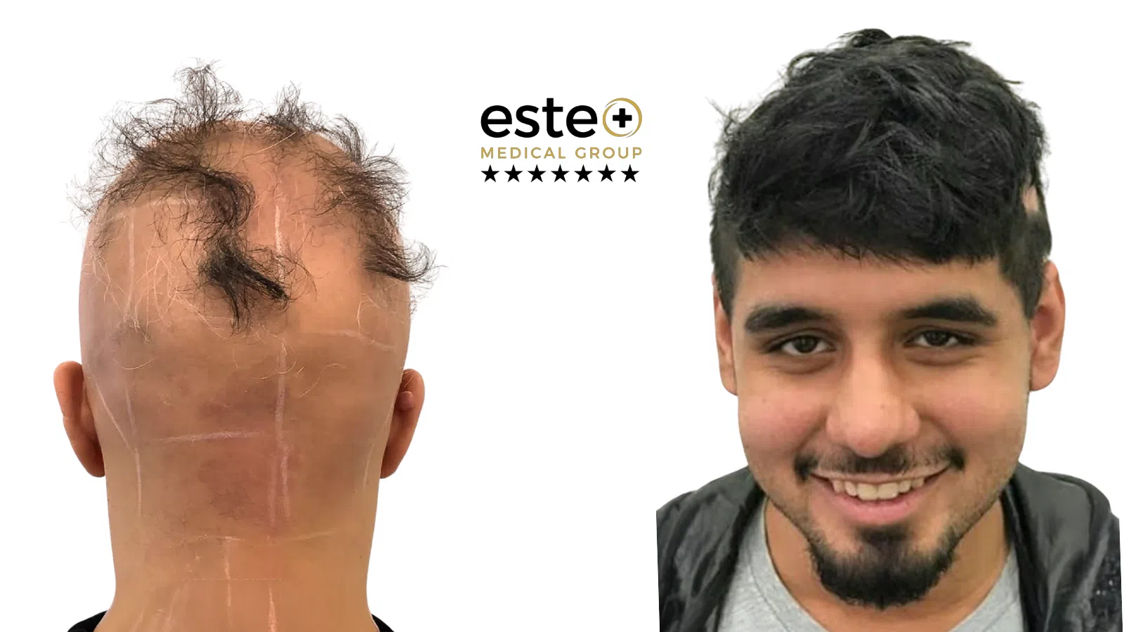 Exciplex (Alopecia Treatment) Life Changing Transformation After and Before Image