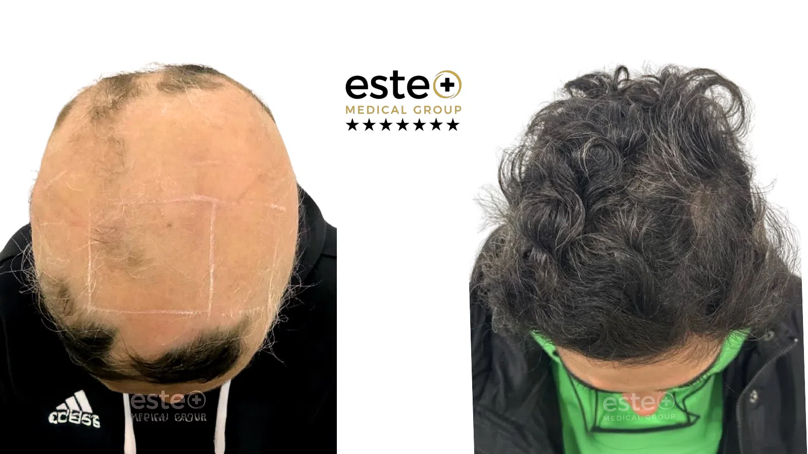 Exciplex (Alopecia Treatment) Life Changing Transformation