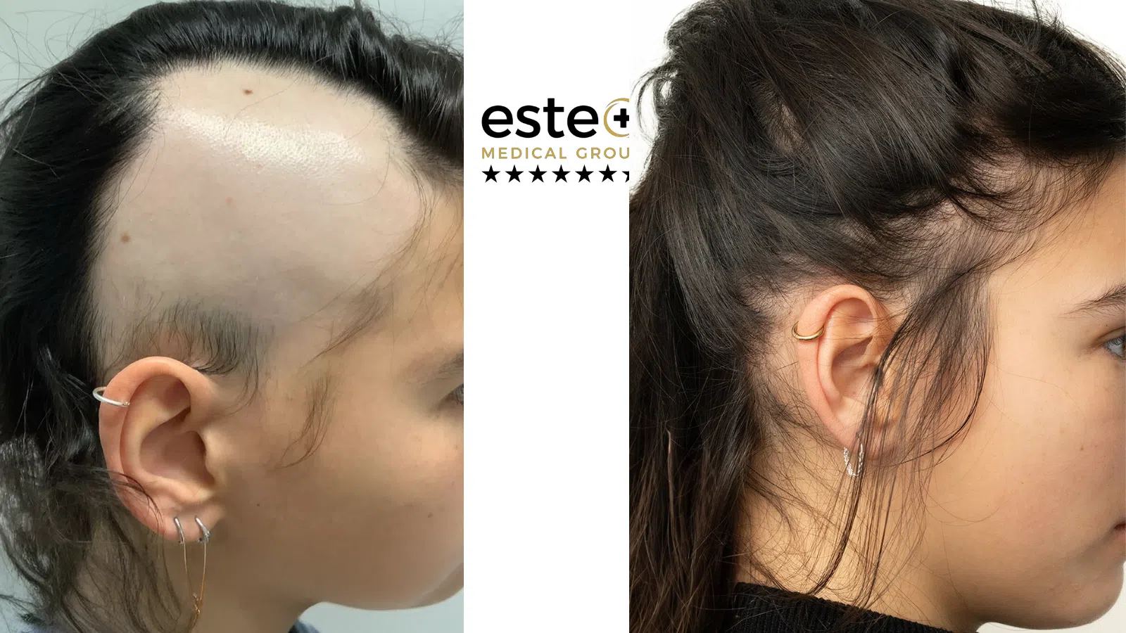 Exciplex (Alopecia Treatment) Life Changing Transformation After and Before Image