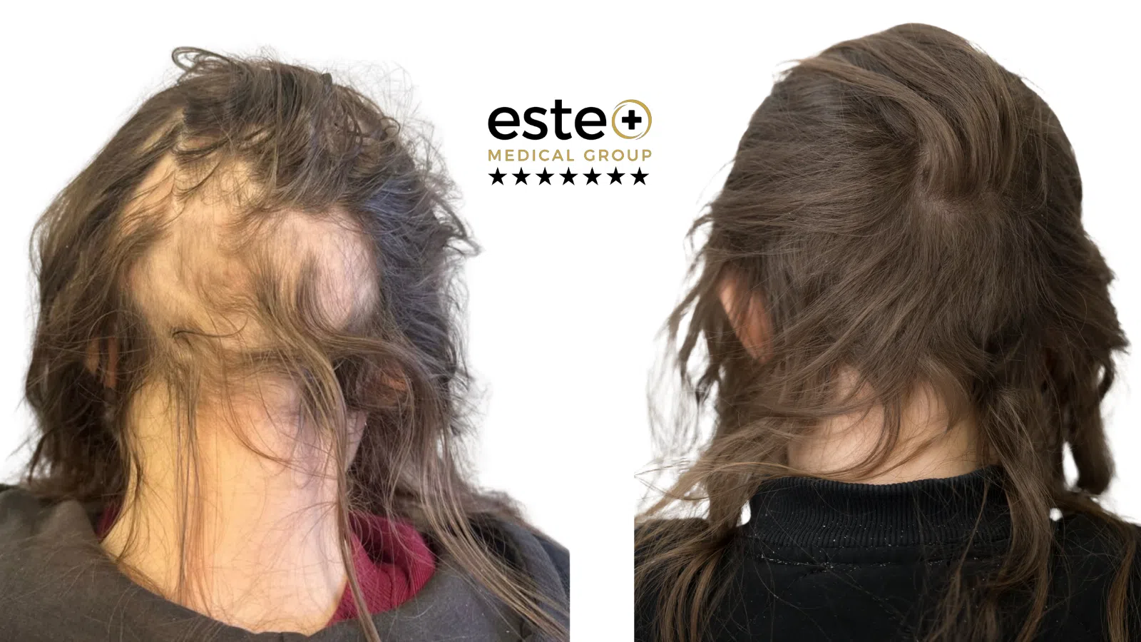 Exciplex (Alopecia Treatment) Life Changing Transformation After and Before Image