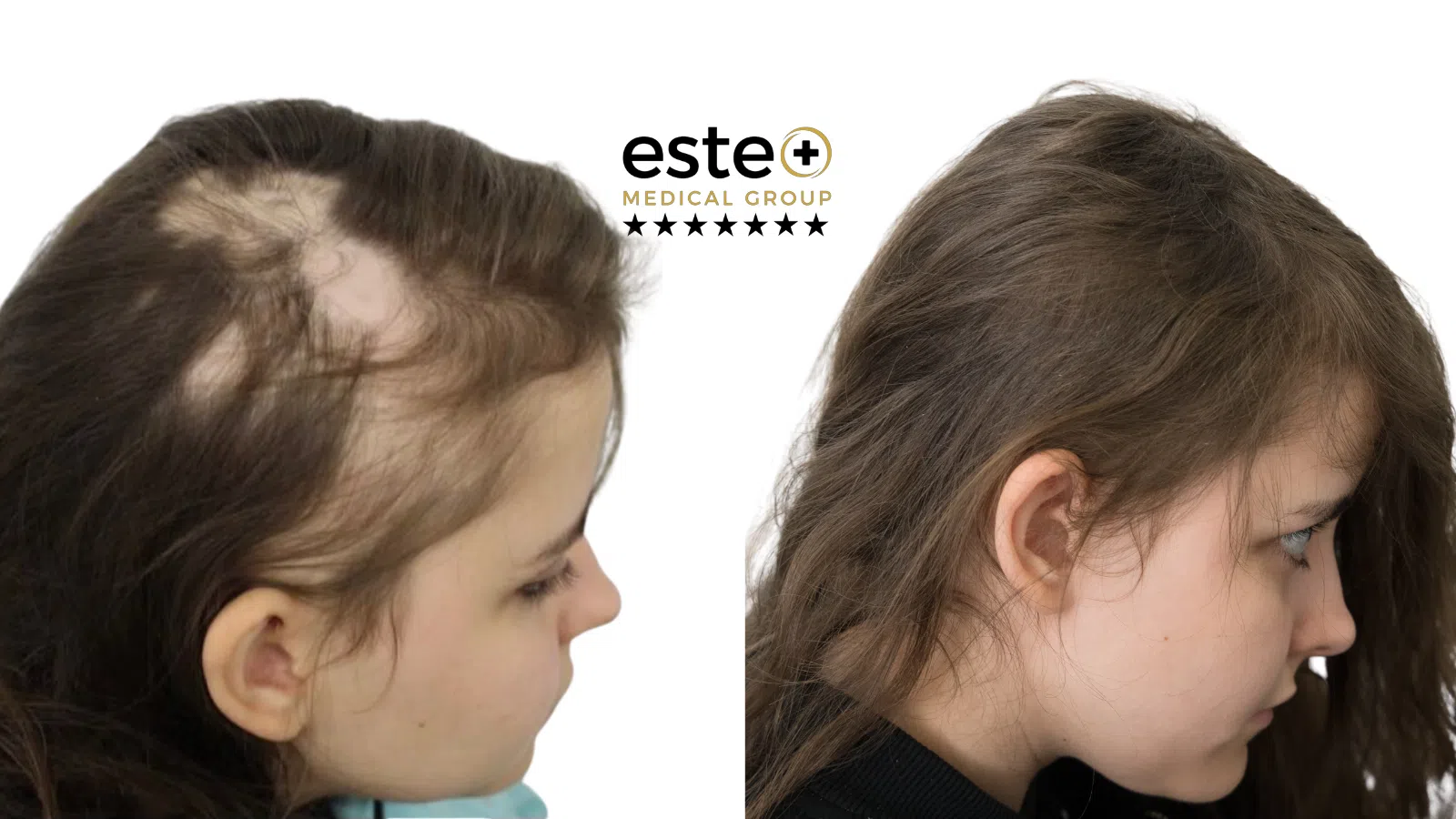 Exciplex (Alopecia Treatment) Life Changing Transformation After and Before Image