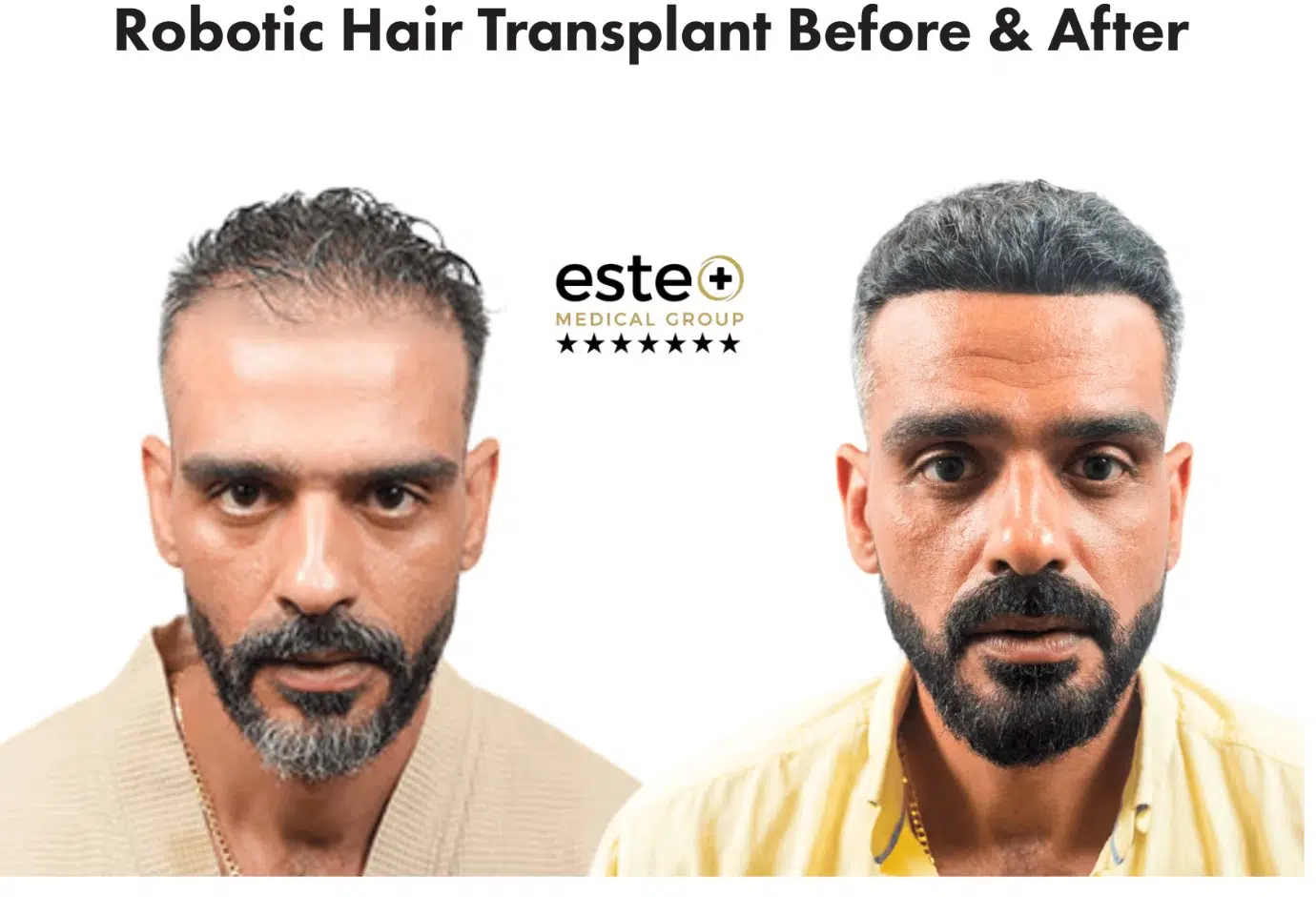 Seif El Hakim Says Dubai Robotic Hair Transplant Is The Alpha Way!