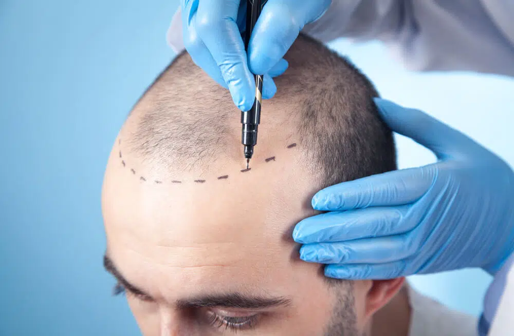Hair Transplant Dubai