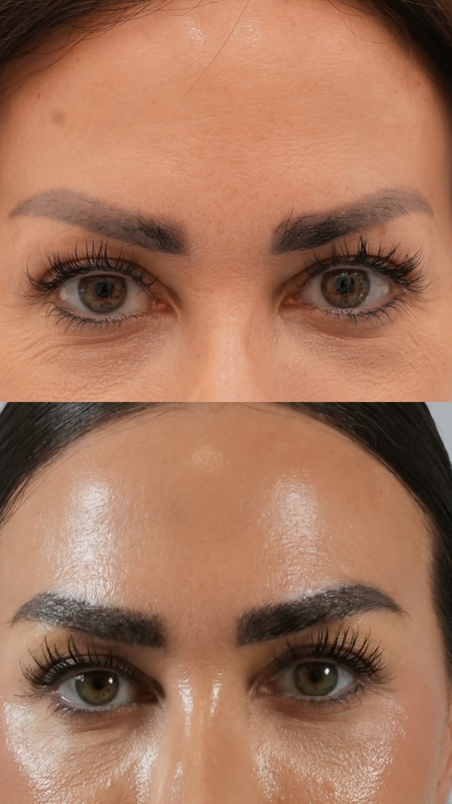 Eyebrow hair transplant before and after