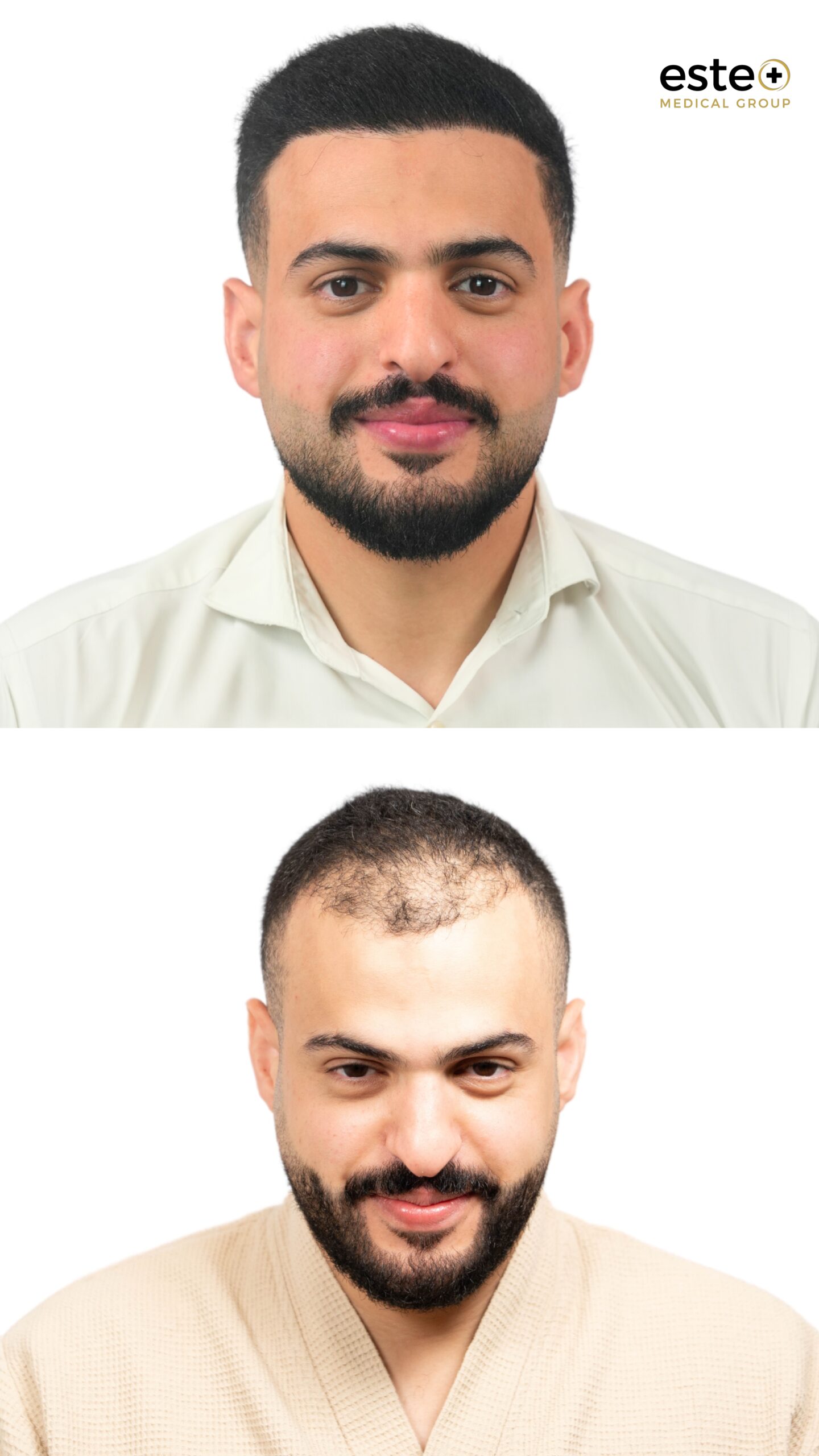 Male hair transplant transformation before and after treatment at Este Medical Group Dubai