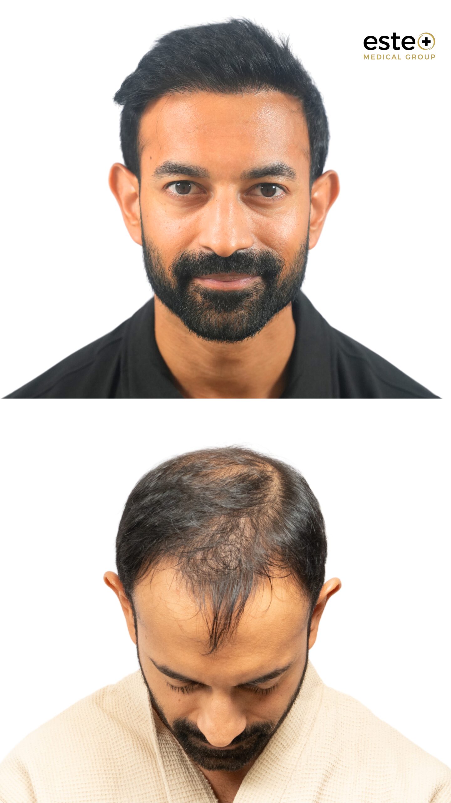 Hairline restoration before and after DHI hair transplant in Dubai