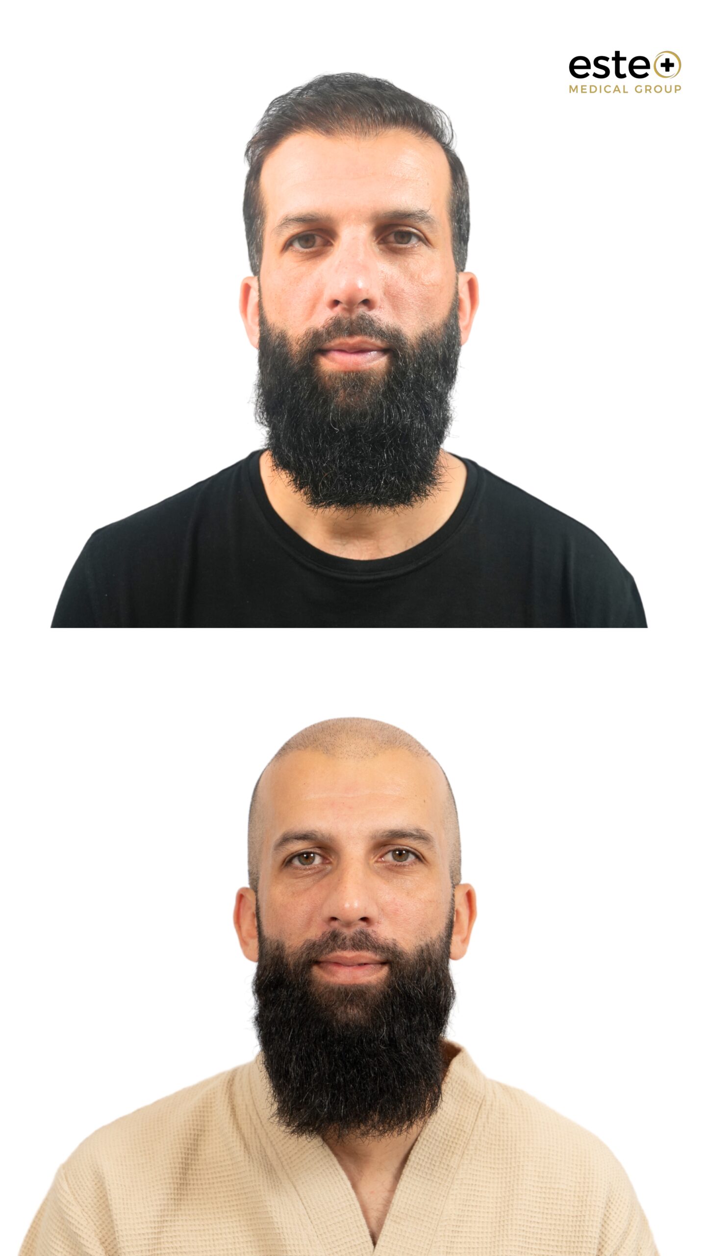 hair transplant crown restoration before after