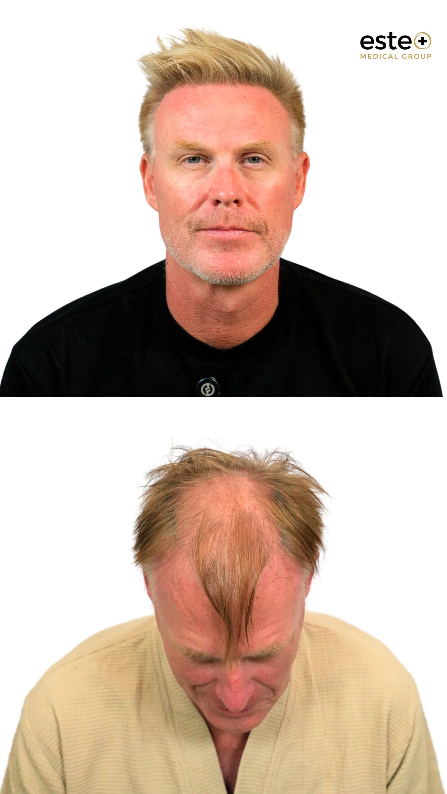 male hair transplant transformation dubai