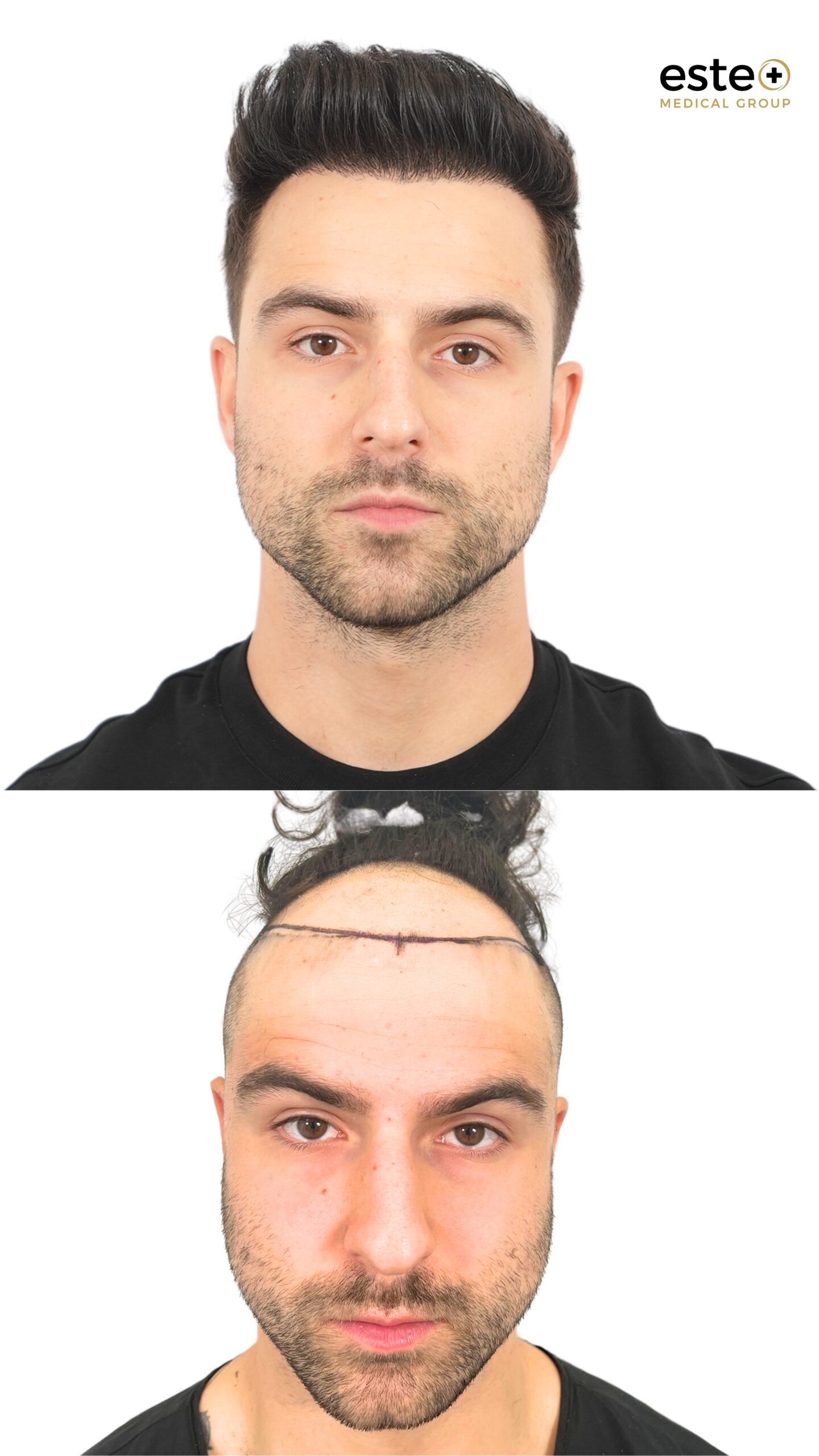 hairline restoration before after dubai