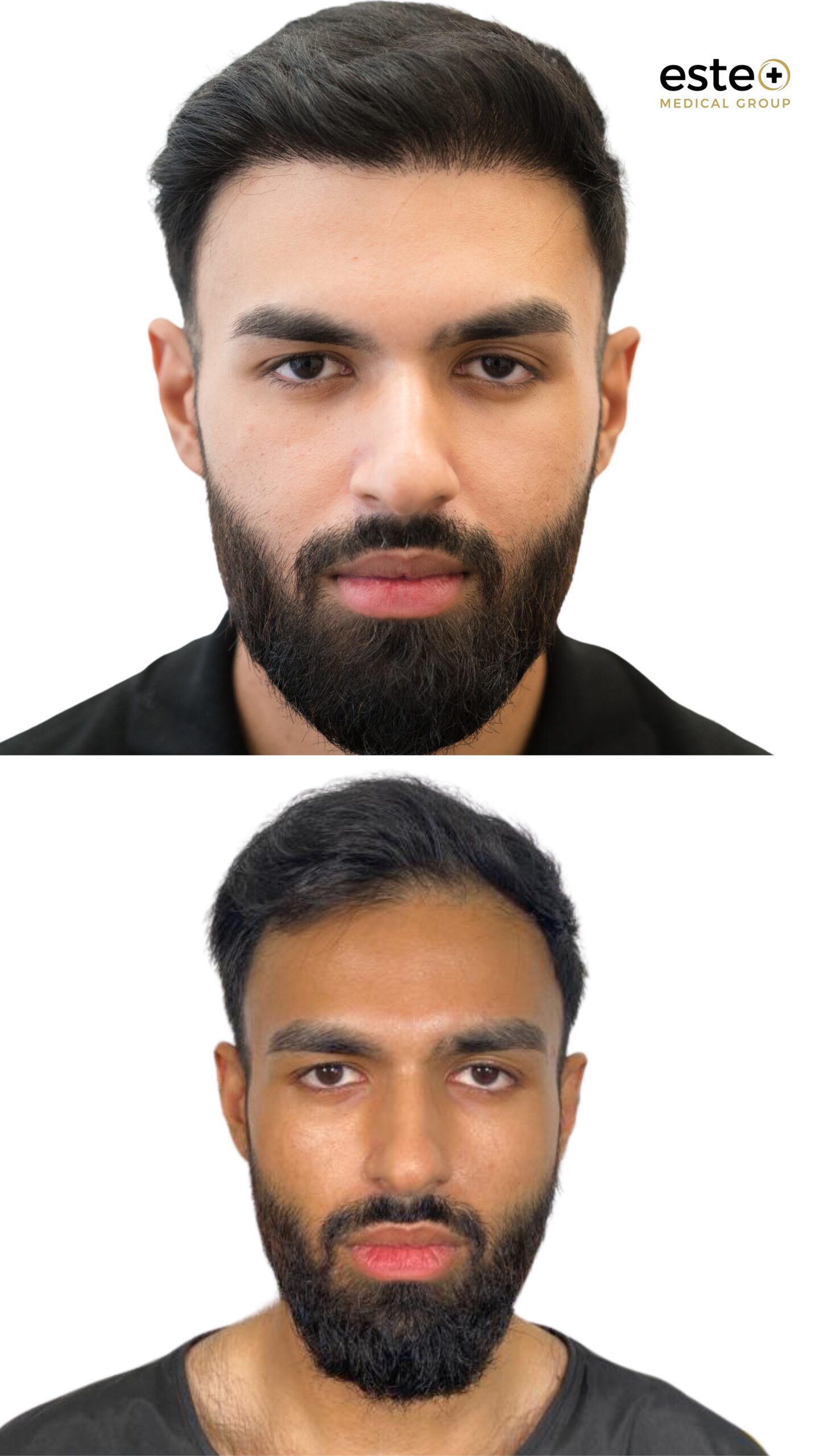 Hair transplant results Dubai showing natural looking hairline and fuller hair
