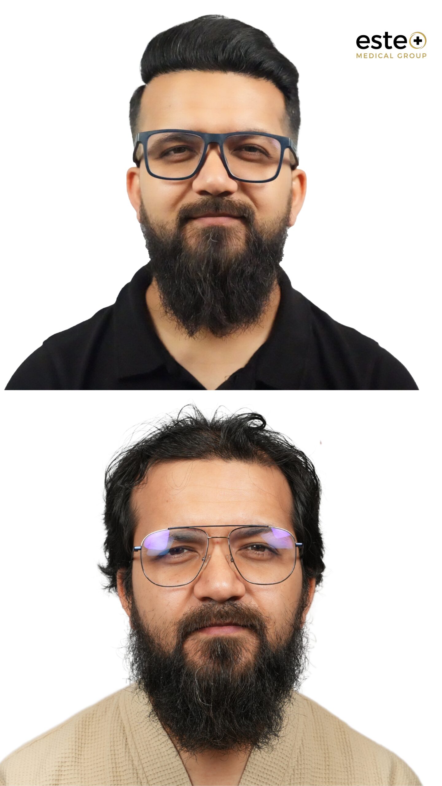 Crown hair loss before and after hair transplant treatment in Dubai clinic